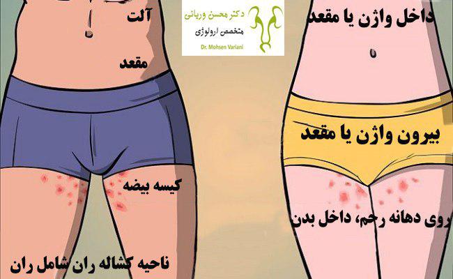 درمان زگیل تناسلی با روش کرایوتراپی 1 phot
