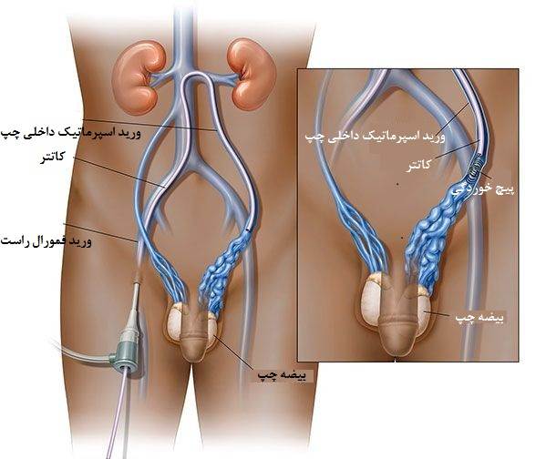 جراحی واریکوسل:لاپاروسکوپی، میکروسکوپیک؛ لیزری و باز 17 امبولیزاسیون از راه پوست