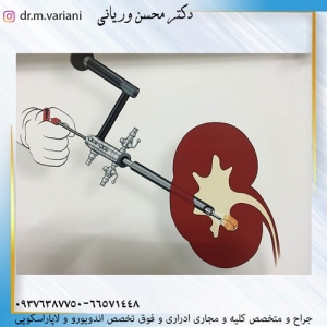 خروج سنگ کلیه از طریق شکاف کوچک پوستی PCNL