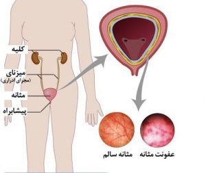 عفونت و درد مثانه
