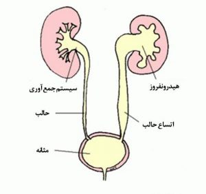 هیدرونفروز کلیه در بزرگسالان